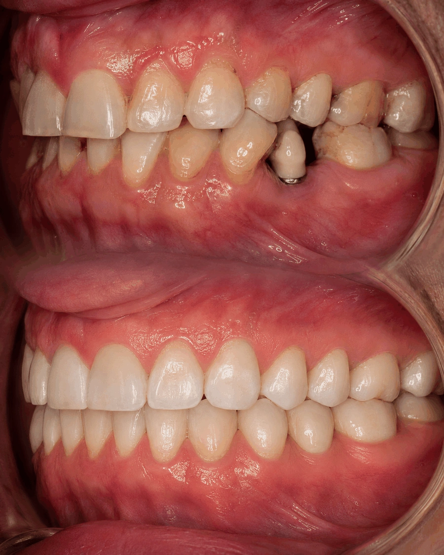 Comparação: acima, dentes desalinhados com espaço insuficiente e implante mal posicionado; abaixo, espaço correto e implante integrado à mordida